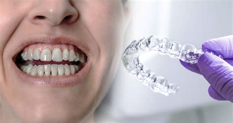 invisalign with attachments pictures